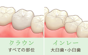クラウン…すべての部位　インレー…大臼歯・小臼歯