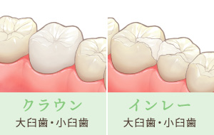 クラウン…大臼歯・小臼歯 インレー大臼歯・小臼歯