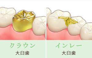 クラウン…大臼歯 インレー…大臼歯