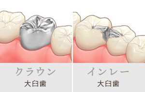 クラウン…大臼歯 インレー…大臼歯