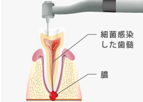 細菌感染した歯髄・膿