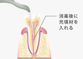 消毒後に充填剤を入れる