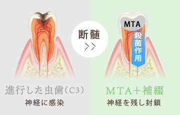 MTA＋補綴