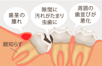 歯茎の腫れ・隙間に汚れがたまり虫歯に・周囲の歯並びが悪化